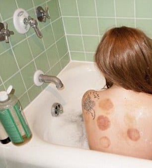 Lady Gaga uses Cupping Therapy For fibromyalgia treatment